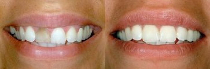 before and after smile