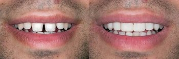 before and after smile