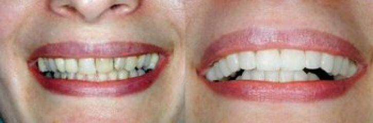 before and after smile