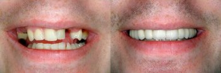 before and after smile