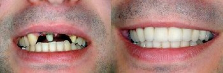 before and after smile